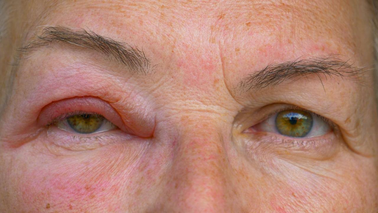 Caucasian lady with an infected and swollen eye looks into the camera.