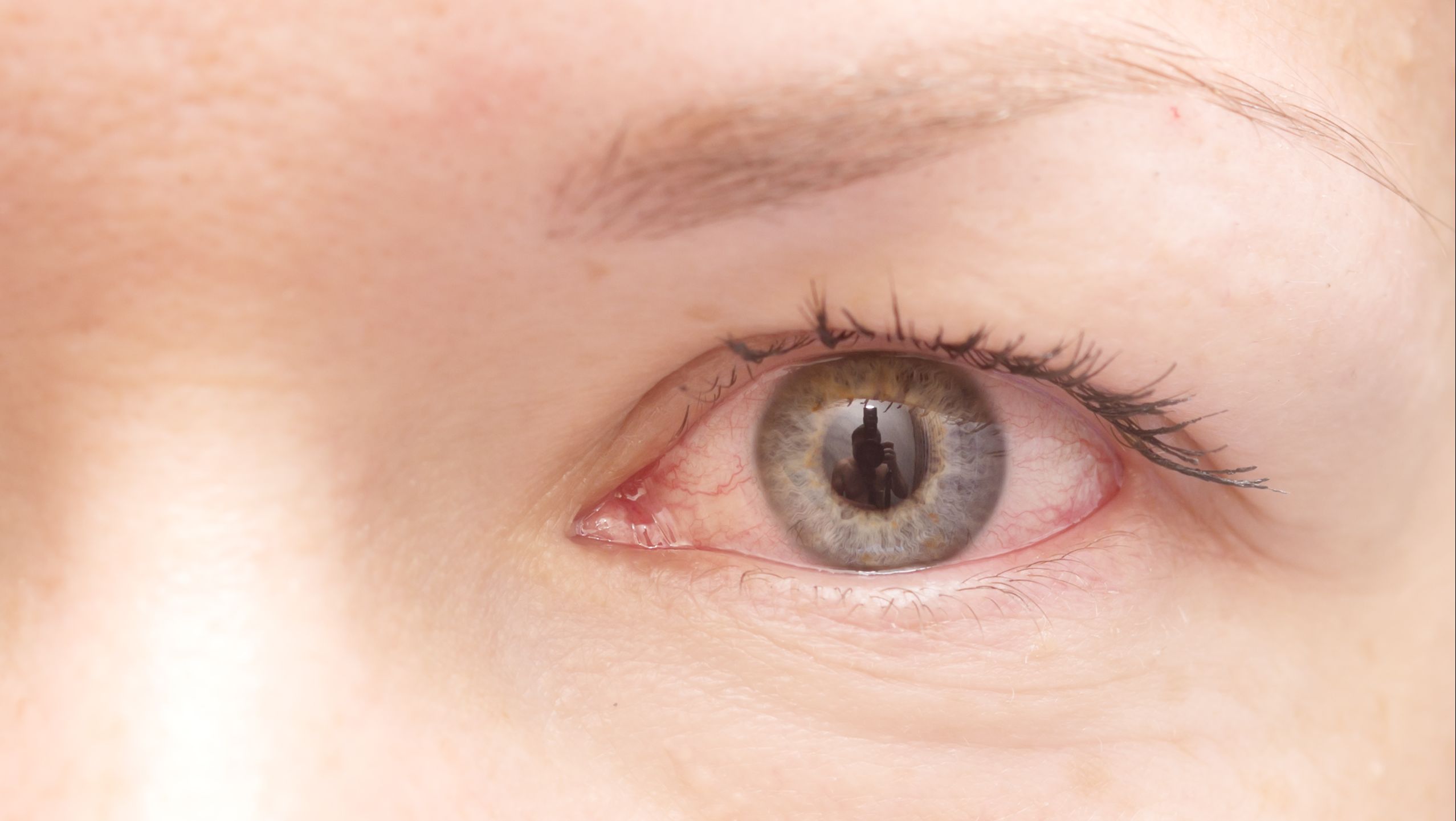 a close up of an irritated and inflamed eye that is red and bloodshot possibly with uveitis